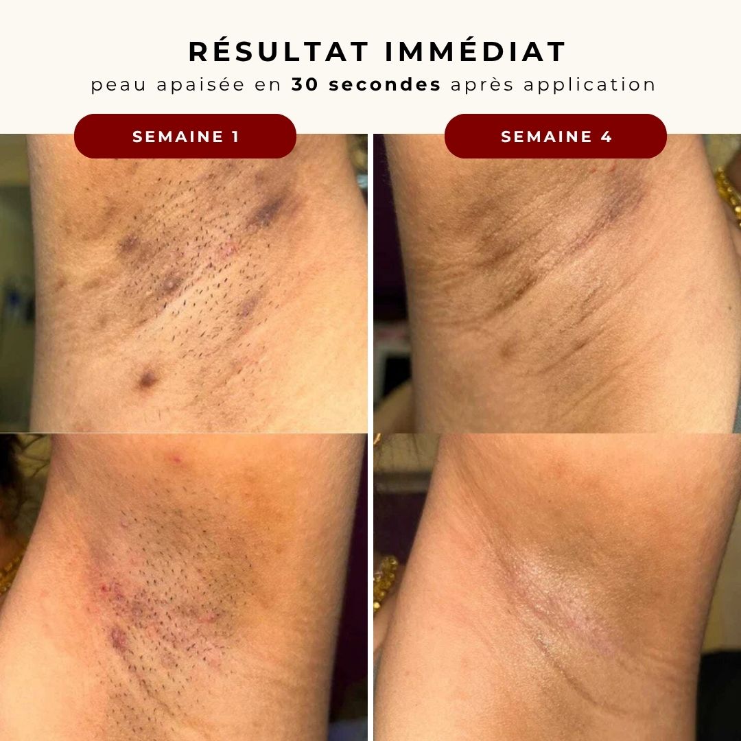 Melanin Glow - Sérum anti poils incarnés